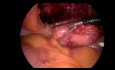 Chirurgie laparoscopique de coupe urachal-tumeur