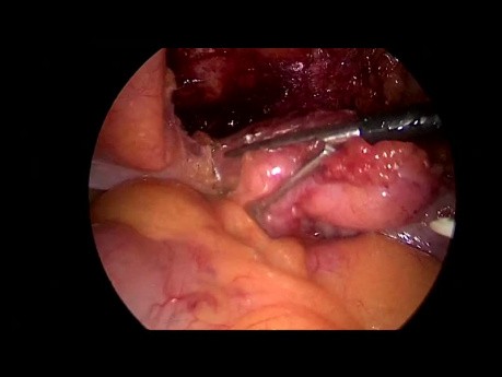 Chirurgie laparoscopique de coupe urachal-tumeur