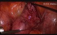 Myomectomie par voie laparoscopique