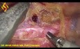 Œsophagectomie Thoraco-Laparoscopique - Partie Thoracique 2