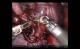 Lobectomie moyenne droite robotique du poumon