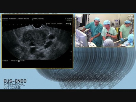 L'échographie endoscopique + le produit de contraste SONOVUE + l'échographie endoscopique et la biopsie à l'aiguille fine