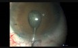 Le rhexis ovale est une petite pupille