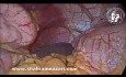 Pneumatose Intestinale de Découverte Fortuite lors d'une Gastrectomie Sleeve