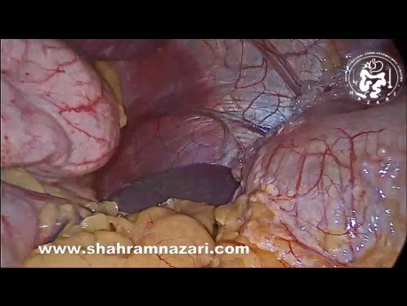 Pneumatose Intestinale de Découverte Fortuite lors d'une Gastrectomie Sleeve