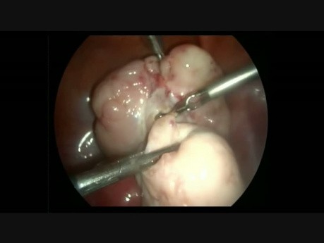 Fibrome ovarien - prise en charge laparoscopique
