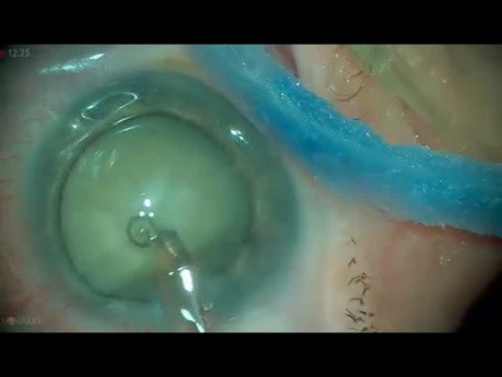 Cataracte intumescente, phacoémulsiphication
