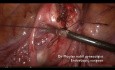 Myomectomie exsangue en ambulatoire