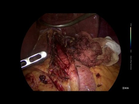 Cardiomyotomie Laparoscopique de Heller + Fundoplicature Dor