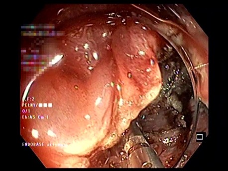 Dissection Sous-Muqueuse Endoscopique (ESD) avec Traction par Elastique et Coagrasper