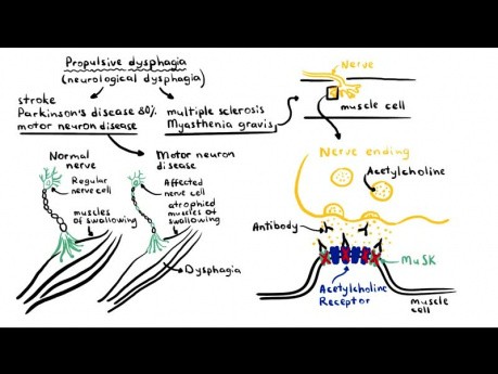 Dysphagie (difficulté à avaler) - causes, physiopathologie, classification, examens