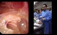Dissection Endoscopique de l'Oreille - Partie I