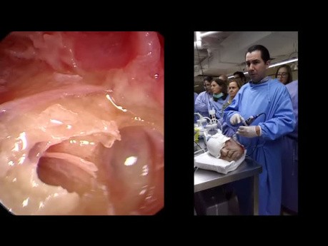 Dissection Endoscopique de l'Oreille - Partie I