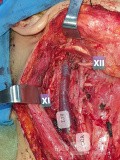 Dissection Sélective du Cou pour Carcinome Papillaire Thyroïdien Droit