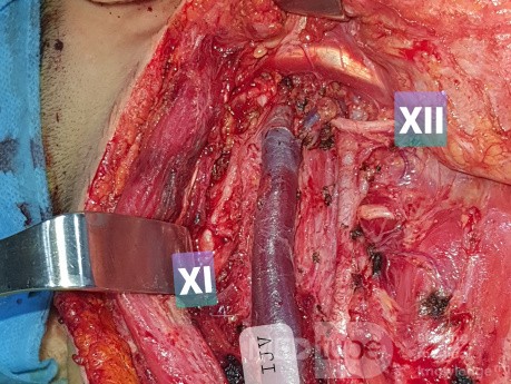 Dissection Sélective du Cou pour Carcinome Papillaire Thyroïdien Droit