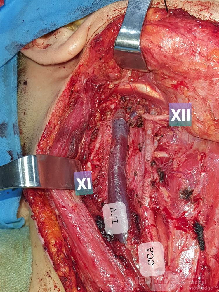 Dissection Sélective du Cou pour Carcinome Papillaire Thyroïdien Droit