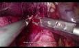 Hémihépatectomie droite par laparoscopie - suture de la veine cave, saignement du parenchyme hépatique