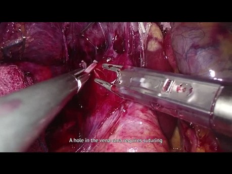 Hémihépatectomie droite par laparoscopie - suture de la veine cave, saignement du parenchyme hépatique