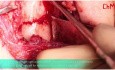 Ostéosynthèse de la Facture du Col Inférieur du Condyle Mandibulaire 