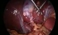Suture et nouage laparoscopique