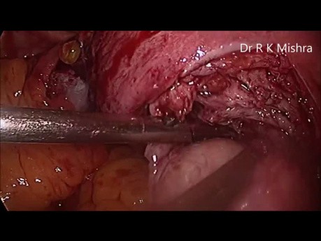 Myomectomie (chirurgie des fibromes utérins)