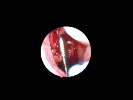 L'adénoïdectomie assistée par rasoir sous contrôle de l'endoscope 0°