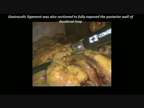 Résection Laparoscopique d'une Tumeur Para-Aortique Située sur la Partie Descendante du Duodénum