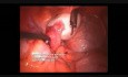 Ablation de Kyste de l'Ovaire et Chromoperturbation