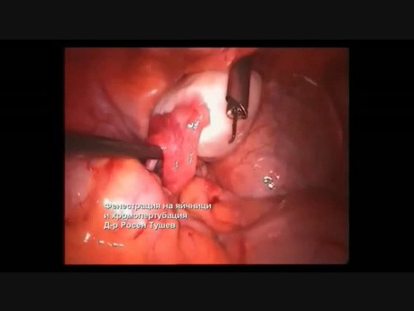 Ablation de Kyste de l'Ovaire et Chromoperturbation