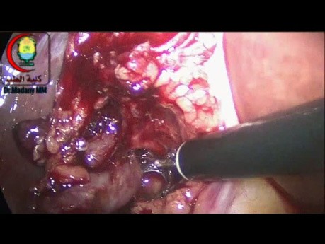 La Dissection de Ganglion Hépatique Porte peut Nécessiter un Chirurgien plus Fin que Moi