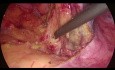 Sigmoïdectomie laparoscopique - mobilisation de l'angle colique gauche par approche médio-latérale