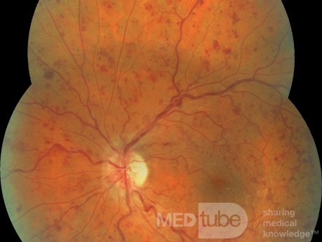 Une thrombose de la veine centrale de la rétine.