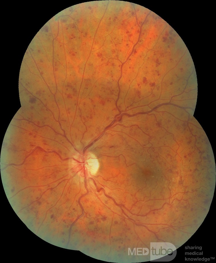 Une thrombose de la veine centrale de la rétine.