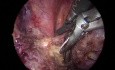 Ablation du schwannome thoracique par thoracoscopie TriPort vidéo-assisté du côté droit