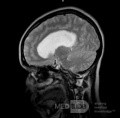  Ventriculostomie endoscopique du troisième ventricule dans un cas bénin du syndrome d'Aicardi avec hydrocéphalie obstructive et malformation de Chiari de type 1.