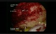 Drainage laparoscopique de l'abcès sous-phrénique droit