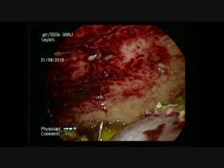 Drainage laparoscopique de l'abcès sous-phrénique droit