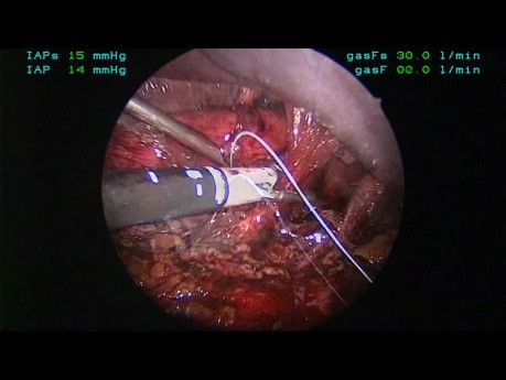 Traitement de la hernie parahiatale par voie laparoscopiqe avec un filet