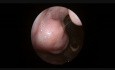 Endoscopie diagnostique de la cavité buccale et du larynx.