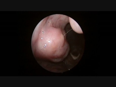 Endoscopie diagnostique de la cavité buccale et du larynx.