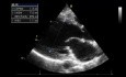 Quiz d'échocardiographie : quelle est la sévérité de l'insuffisance aortique?