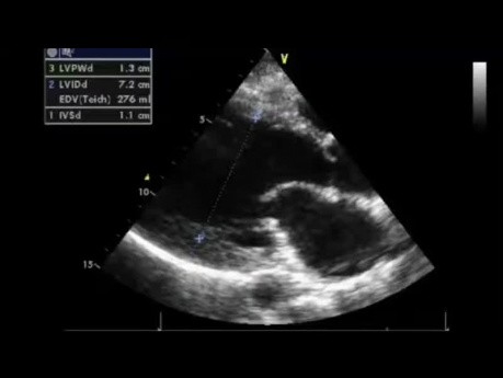 Quiz d'échocardiographie : quelle est la sévérité de l'insuffisance aortique?