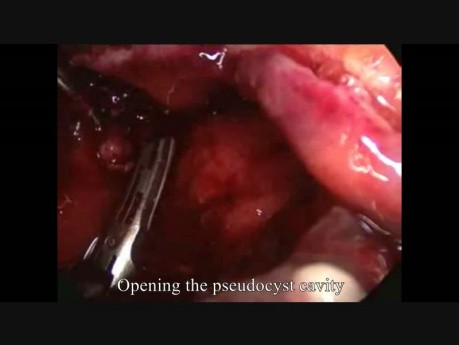 Pseudokyste pancréatique infecté - prise en charge laparoscopique