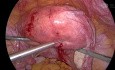 Myomectomie Laparoscopique 