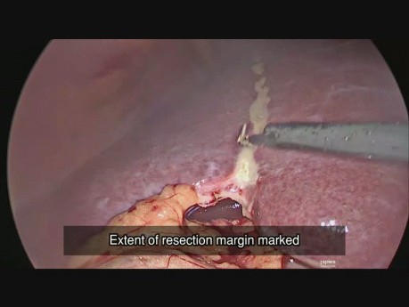 Ablation du lobe droit de foie par voie laparoscopique