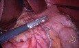 Gastrectomie Sleeve 