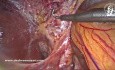 Cholécystectomie Laparoscopique Sûre