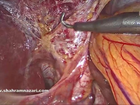 Cholécystectomie Laparoscopique Sûre