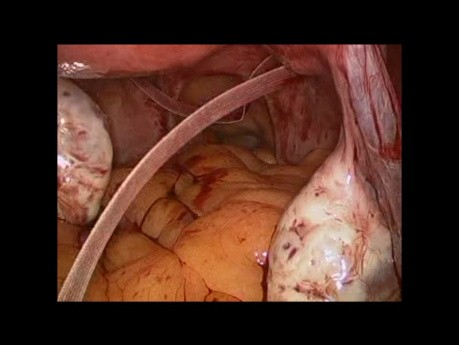 La mise en place d'un cerclage par voie abdominale, laparoscopique