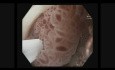 Résection Mucosale Endoscopique Sous-Marine (UEMR)